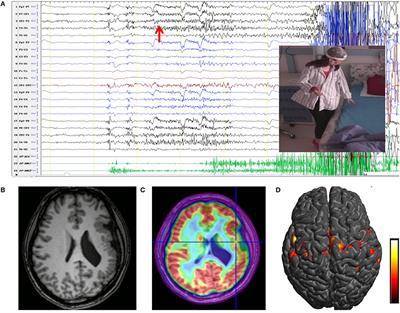Multiple <mark class="highlighted">Stereoelectroencephalography</mark>-Guided Radiofrequency Thermocoagulations for Polymicrogyria With Startle Seizures: A Case Report